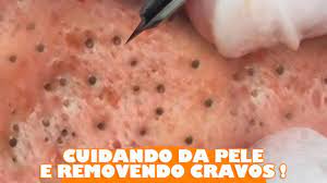 Mário cravo neto, father and worldwide renown photographer. Cuidando Da Pele E Removendo Cravos Video Satisfatorio Youtube