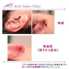 ピアス しこり 除去