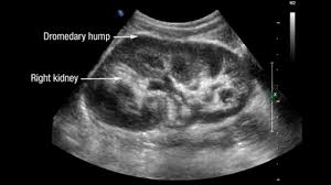 The hump nearly disappears and flops over when the fat store in it is used up. Dromedary Hump Ultrasound Images
