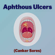 Image result for Canker sores symptoms roof of the mouth