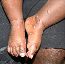 Image result for scabies effects on the human body