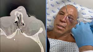 Wanderlei Silva heeft zijn neus gebroken en een niet zo'n geweldig viraal  KO-moment van de vechtpartij na de diskwalificatie. : r/MMA