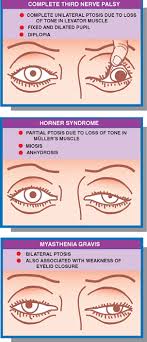 No definite reason has been discovered as to why some horses develop the problem. Ocular Motor System Neupsy Key