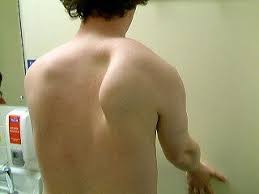 Image result for Winged Scapula