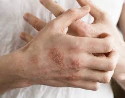 Pesakit eczema yang teruk, mengalami perubahan sembuh yang ketara setelah 4 hari selepas rawatan pertama. Treatment For Eczema Eczema Treament Specialist Skin Clinic
