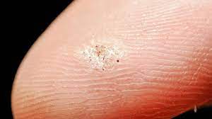 Maybe you would like to learn more about one of these? Seed Warts Contagious On Fingers Home Remedies On Foot