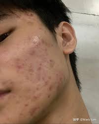 有什么方法可以完全祛痘（一点痘痘不剩的那种）？