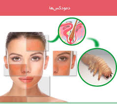 The symptoms of the demodectic human mites are often similar to other skin conditions. Ø§Ú¯Ø± Ù…Ø¨ØªÙ„Ø§ Ø¨Ù‡ Ø¢Ú©Ù†Ù‡ Ù…Ù‚Ø§ÙˆÙ… Ø±ÙˆØ²Ø§Ø³Ù‡ Ø¨Ù„ÙØ§Ø±ÛŒØª Ùˆ Ø³Ø§ÛŒØ± Ù…Ø´Ú©Ù„Ø§Øª Ù¾ÙˆØ³ØªÛŒ Ù‡Ø³ØªÛŒØ¯ Ú©Ù‡ Ø¯Ø±Ù…Ø§Ù† Ù†Ù…ÛŒ Ø´ÙˆÙ†Ø¯ ØªØ±Ø§Ú©Ù… Ø§Ù†Ú¯Ù„ Ù‡Ø§ÛŒ Ø¯Ù…ÙˆØ¯Ú©Ø³ Ø®ÙˆØ¯ Ø±Ø§ Ø¨Ø± Face Skin Problems Demodex Hair Treatment