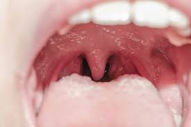 Image result for Tonsillectomy