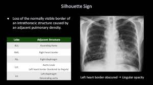 How To Interpret A Chest X Ray Lesson 8 Focal Lung Processes Youtube