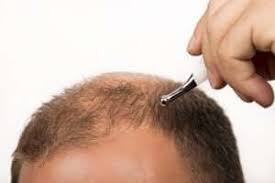 تقنية زراعة الشعر من دون ألم Best Hair Transplant Hair Transplant Results Hair Transplant