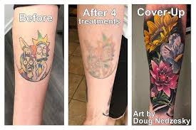 I was one of those unlucky women who was born with lots of hair, everywhere. Disappearing Ink Laser Tattoo Removal Home Facebook
