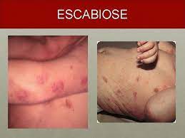 Mites and burrows are frequently found in nodular scabies by dermoscopy and histopathology. Doenas De Pele Na Infncia Internato Escs Amanda