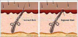 Use a circular motion for several minutes. What Causes Ingrown Hair And How To Get Rid Of It