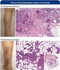 Image result for Panniculitis