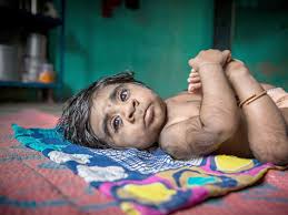 Hypertrichosis or human werewolf syndrome is growth of excessive hair, either all over the body or in specific areas of the body. Incredible Photos Show Five Month Old Werewolf Syndrome Baby Covered In Hair Daily Star