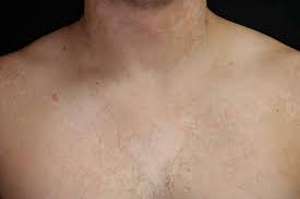 Pityriasis versicolor is classically a disease affecting young people around the pubertal time probably related with hormonal changes and increase in sebum secretion. Tinea Versicolor Pityriasis Versicolor Dermatology Advisor