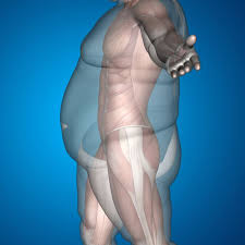 It will greatly change your lifestyle. Mini Gastric Bypass Scars Tijuana Mexico