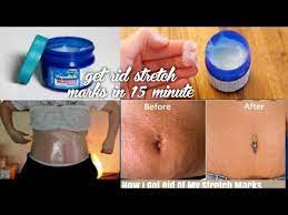 How To Remove Stretch Marks Using Vicks Vaporub Remove Stretch Marks At Home Youtube