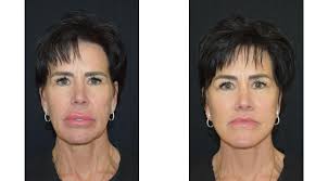 4-week post-op results of facial procedures in Austin, Texas