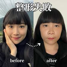 NanaQ整完型「臉嚴重腫脹」！隔天枕頭驚見大片血跡崩潰：damn】 💡星光雲App掌握明星大小事： https://goo.gl/DxAfcG