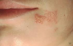 A newborn baby with a baby rash in soft focus. Herpes Simplex Dermatology Tribeca Ny Downtown Dermatology