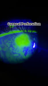 Image result for Seidel Test