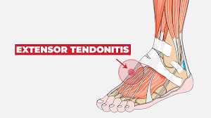 Anterior tibial tendonitis — causes pain on the front of your foot, typically felt when walking down the most common symptoms of foot or ankle tendonitis are localized pain, swelling, and stiffness. 29 Quick Solutions That Every Runner With Foot Pain Need To Know