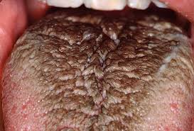 Image result for black hairy tongue symptoms