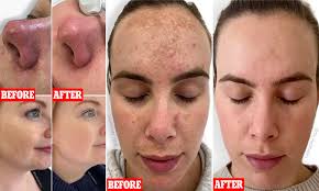 I've just done my 3rd treatment . Women Rave About New 200 Non Invasive Ipl Treatment Daily Mail Online