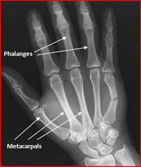 Image result for Hand Fracture