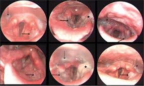 Image result for Acute Laryngitis