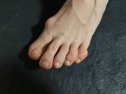 Image result for gout symptoms toe