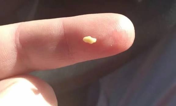Bad breath caused by tonsil stones