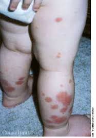 Discussion children presenting with rashes are common but certain characteristics may be concerning such as descriptions of petechiae or purpura. Toddler With Henoch Schonlein Purpura