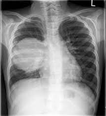 Ct scans can rule out or decide if mesothelioma is suspected relying on the findings of the scan. Malignant Pleural Mesothelioma In A Child Sciencedirect