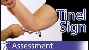 The hoffman's sign can be a useful test to help determine if a person has an upper motor neuron here is a video of the hoffman's sign performed in slow motion on a patient with severe central. Tinel S Sign S At The Elbow Cubital Tunnel Syndrome Clinical Examination Of The Musculoskeletal System