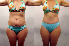 Mommy Makeover surgery