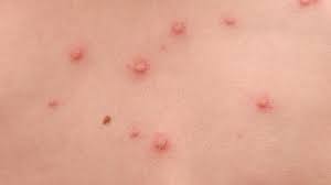 The infection will have to be in your body for around seven to 21 days before the rash and other symptoms develop. á… Windpocken Bei Erwachsenen