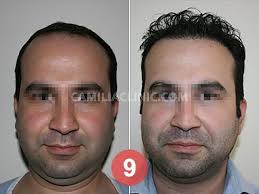 نتائج عملية زراعة الشعر بعد 10 اشهر في تركيا زراعة 4300 بصيلة شعر بتقنية الاقتطاف 00905444488340 Www Camiliaclinic Com Hair Transplant Hairstyles