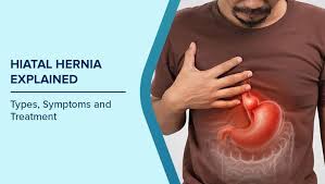 Image result for stomach hernia symptoms