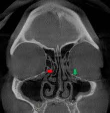 It may narrow the ipsilateral ostiomeatal. Jcdr Concha Bullosa Haller Cell Inflammatory Diseases Maxillary Accessory Ostium Sinus Mucosa