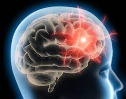 Soulager les maux de te te en 9 minutes. Cephalees Maux De Tete Symptomes Traitement Definition Docteurclic Com