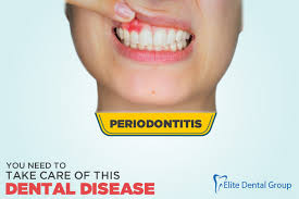 Chronic periodontitis has been defined as an infectious disease resulting in inflammation within the supporting tissues of the teeth, progressive attachment loss, and bone loss. Periodontitis You Need To Take Care Of This Dental Disease