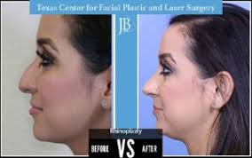 Top Rhinoplasty surgeon in San Antonio, TX