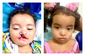 I was thrilled to receive these #plasticsurgerybeforeandafter photos from  my lovely patient @barbaracorcoran after I performed her #deepplanefacelift  and I think she looks stunning!! She looks better