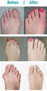 Bunionfree Elastic Bunion Corrector 1 Pair Bunion Remedies Bunion Cure Skin Tightening Stomach