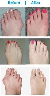 A bunion is a deformity of the foot that causes the big toe to turn inward toward the other toes. Bunionfree Elastic Bunion Corrector 1 Pair Bunion Cure Bunion Remedies Bunion Treatment
