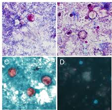 Image result for Cyclospora