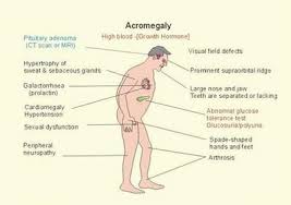 Image result for Acromegaly